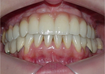 Dentes em porcelana sobre implantes superiores - Clínica Cliniface
