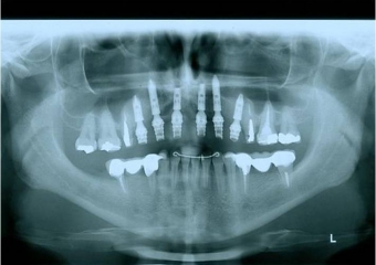 Raio x com prótese provisória fixa sobre implantes - Clínica Cliniface