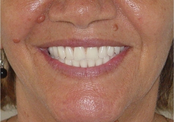 Sorriso final, do caso terminado em Janeiro de 2014 - Clínica Cliniface