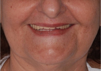 Sorriso inicial - Clínica Cliniface