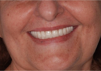 Sorriso final, do caso terminado em setembro de 2013 - Clínica Cliniface