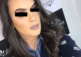 Foto após a cirurgia  - Clínica Cliniface