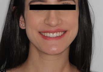 Foto após a cirurgia 2019 - Clínica Cliniface