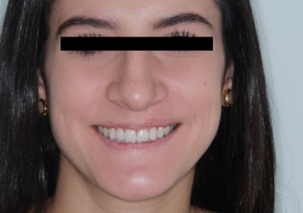 Foto após a cirurgia 2017 - Clínica Cliniface