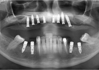 Raio X dos implantes superiores Cone Morse - Clínica Cliniface