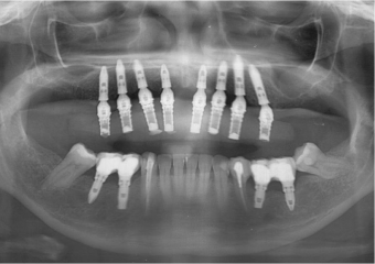 Raio X com prótese fixa superior provisória instalada - Clínica Cliniface