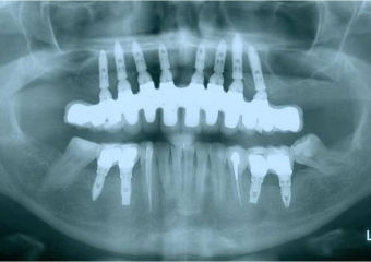 Raio X com prótese fixa em porcelana - Clínica Cliniface
