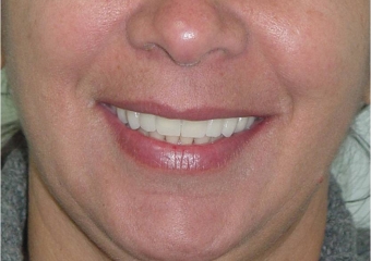 Sorriso final, do caso terminado em Junho de 2013 - Clínica Cliniface