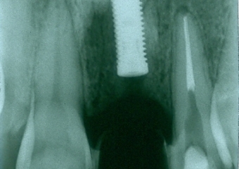 Raio X do implante instalado - Clínica Cliniface