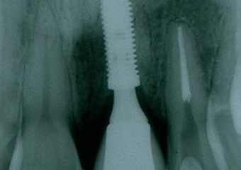 Raio X com dente de porcelana instalado - Clínica Cliniface