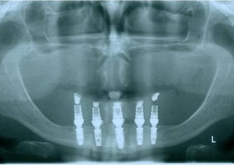 Raio x após prótese imediata fixa inferior e nova prótese superior, provisórias instaladas - Clínica Cliniface