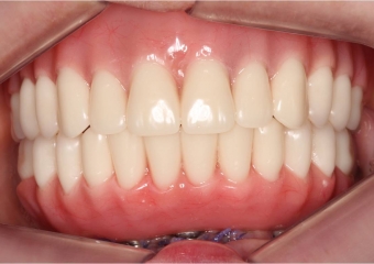 Imagem após prótese imediata fixa inferior e nova prótese superior, provisórias instaladas - Clínica Cliniface