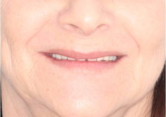 Sorriso inicial - Clínica Cliniface