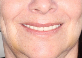 Sorriso após próteses provisórias instaladas - Clínica Cliniface