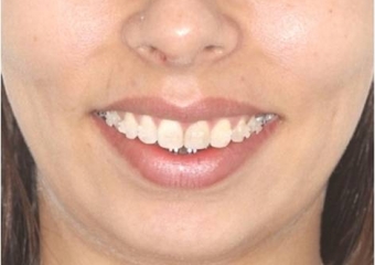 Sorriso inicial - Clínica Cliniface