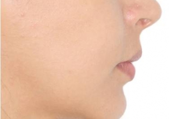 Perfil com 90 dias, após a cirurgia - Clínica Cliniface