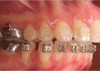 Mordida inicial - Clínica Cliniface