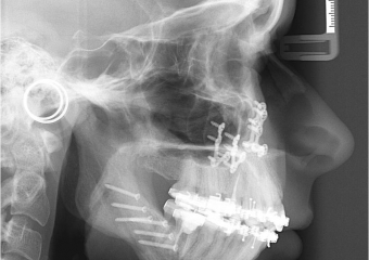 Telerradiografia com 90 dias, após a cirurgia - Clínica Cliniface
