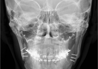 Telerradiografia frontal com 90 dias, após a cirurgia - Clínica Cliniface