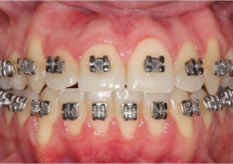 Mordida inicial - Clínica Cliniface