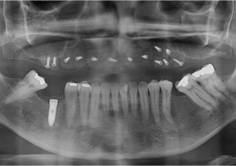 Raio x após enxerto na maxila, com osso de mandíbula - Clínica Cliniface