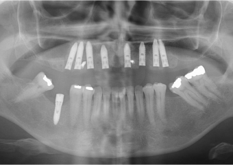 Raio x após instalação dos implantes superiores Cone Morse - Clínica Cliniface