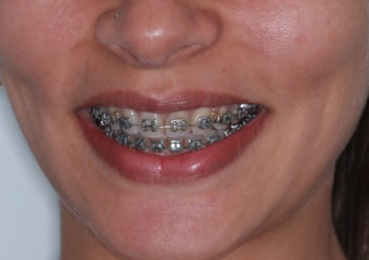 Sorriso após cirurgia (Controle 14 meses) - Clínica Cliniface