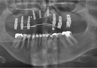 Raio x após 3 implantes Cone Morse instalados - Clínica Cliniface