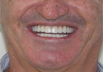 Imagem com 2 anos de controle - Clínica Cliniface