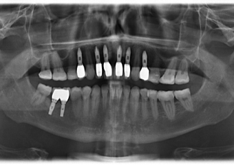 Raio x após substituição das próteses de porcelana - Clínica Cliniface