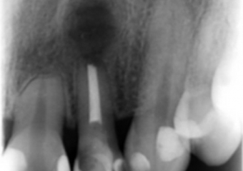Raio x após curetagem da lesão e plastia apical do dente 22 - Clínica Cliniface