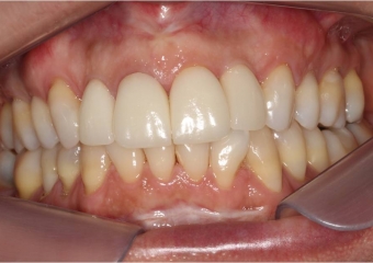 Imagem final da prótese em porcelana instalada sobre o implante - Clínica Cliniface