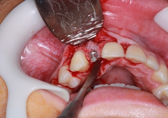 Foto cirurgia de instalação do implante 11/05/2018 - Clínica Cliniface