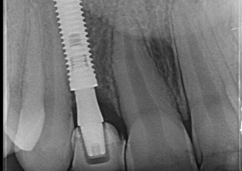 Rx Periapical de controle de 1 mês e 8 dias 19/06/2018  - Clínica Cliniface