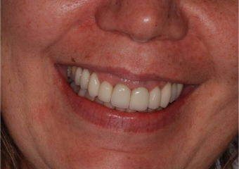 Sorriso inicial - Clínica Cliniface