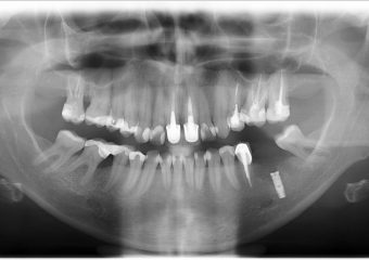 Raio X após instalação de um implante inferior - Clínica Cliniface