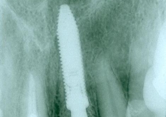 Raio X com prótese provisória fixa sobre o implante - Clínica Cliniface