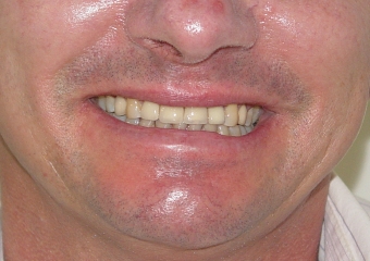 Sorriso final, do caso terminado em Novembro de 2012 - Clínica Cliniface