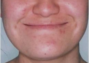 Imagem inicial com assimetria de face  - Clínica Cliniface