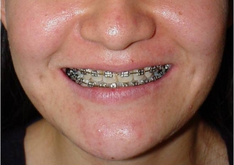 Imagem após a cirurgia - Clínica Cliniface