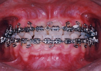 Mordida inicial - Clínica Cliniface