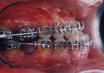 Mordida inicial - Clínica Cliniface