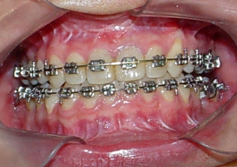 Mordida após a cirurgia - Clínica Cliniface