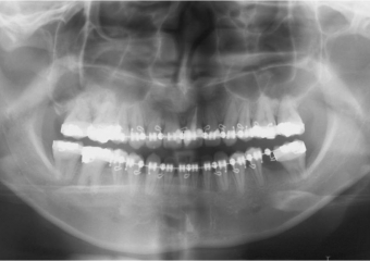 Raio x panorâmico inicial - Clínica Cliniface