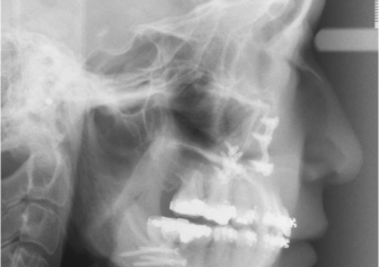 Telerradiografia após a cirurgia - Clínica Cliniface