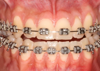 Mordida inicial - Clínica Cliniface