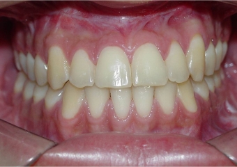 Mordida final - Clínica Cliniface