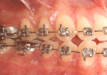 Mordida perfil inicial - Clínica Cliniface