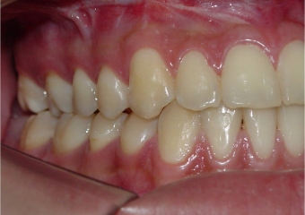 Mordida perfil final - Clínica Cliniface