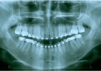 Raio x panorâmico inicial - Clínica Cliniface